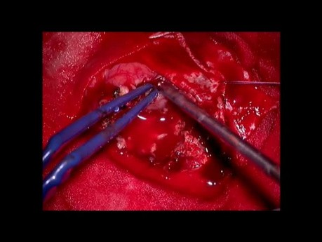 Glioblastoma