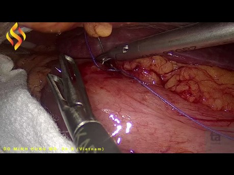 Extracción laparoscópica de un cuerpo extraño perforado en la pared del estómago