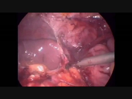 Proctocolectomía total y anastomosis ileoanal con bolsa en J