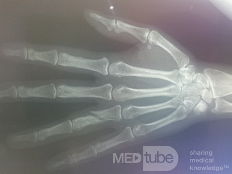 Radiografía de la mano