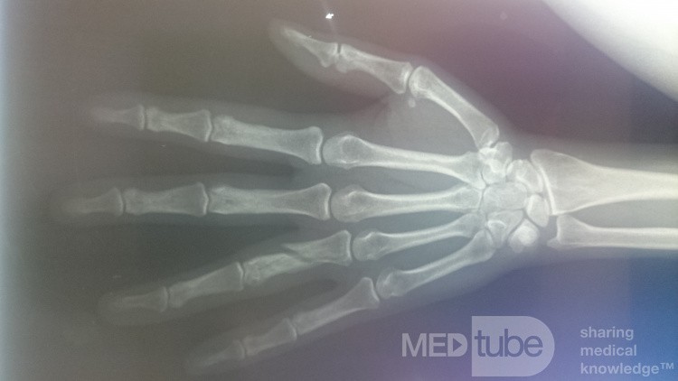 Radiografía de la mano