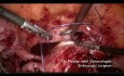 Miomectomía difícil (mioma uterino submucoso de 11 cm)