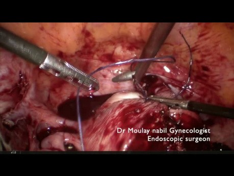 Miomectomía difícil (mioma uterino submucoso de 11 cm)