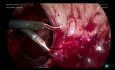 Extirpación por enterólisis laparoscópica del hidrosalpinx izquierdo (Parte 3)