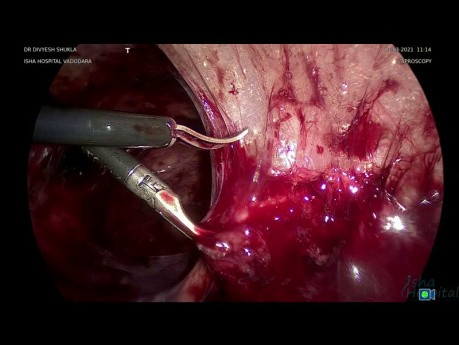 Extirpación por enterólisis laparoscópica del hidrosalpinx izquierdo (Parte 3)