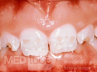 Hipoplasia dental