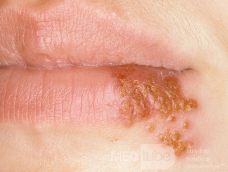 Herpes simple en el labio inferior [en resolución]