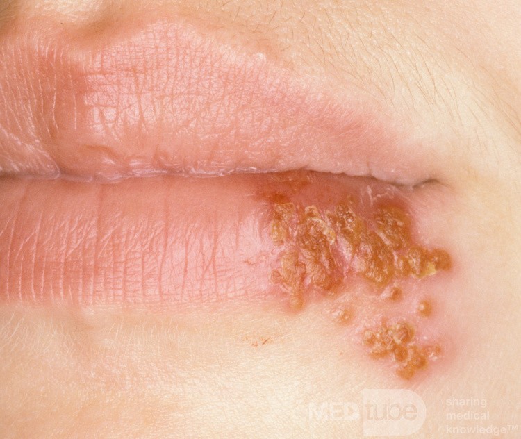 Herpes simple en el labio inferior [en resolución]
