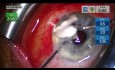 Tubo de derivación de glaucoma bloqueado por vítreo