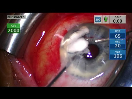 Tubo de derivación de glaucoma bloqueado por vítreo