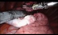 Una masa pulmonar izquierda eliminada con un robot quirúrgico