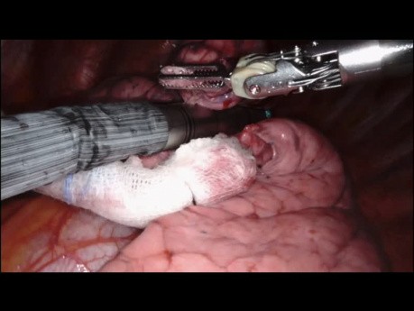 Una masa pulmonar izquierda eliminada con un robot quirúrgico