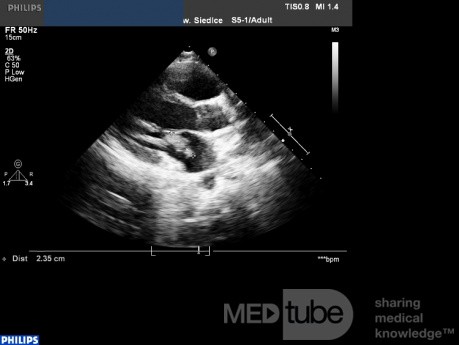 Endocarditis - Vegetación de la válvula mitral