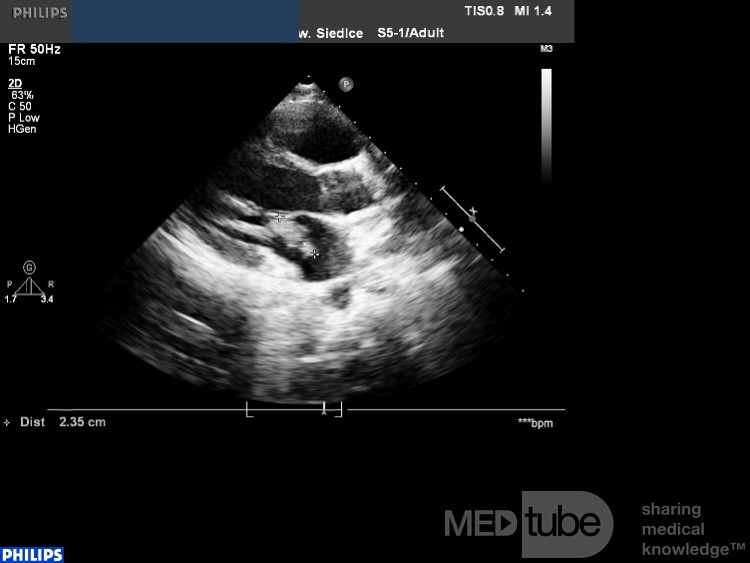 Endocarditis - Vegetación de la válvula mitral