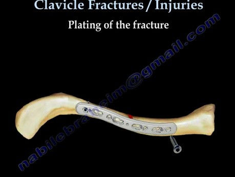 Fracturas de clavícula - métodos de tratamiento