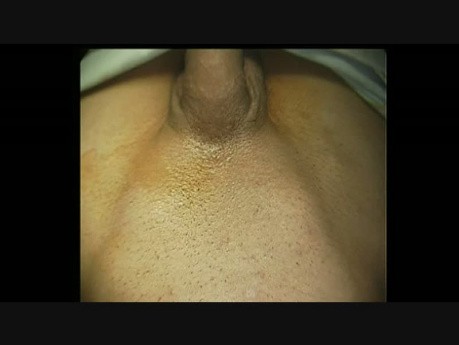 Reparación laparoscópica de hernia inguinal - paso a paso - identificación percutánea de los defectos