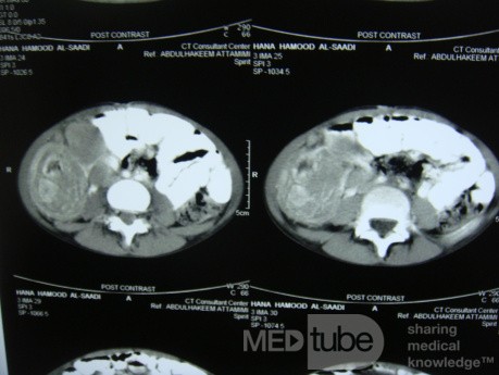 Intususcepción, linfoma no Hodgkin - TC