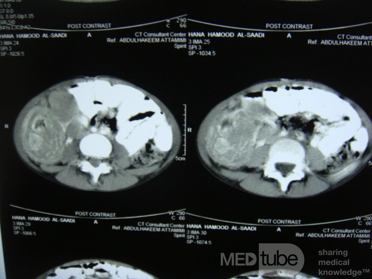 Intususcepción, linfoma no Hodgkin - TC