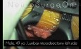 Microdiscectomía lumbar simple