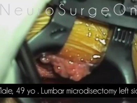Microdiscectomía lumbar simple