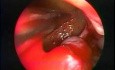 Pólipo colgante del seno maxilar - extirpación endoscópica