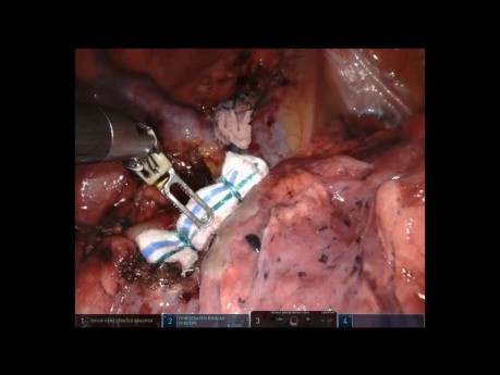 Segmentectomía robótica del lóbulo superior derecho S1 sin editar