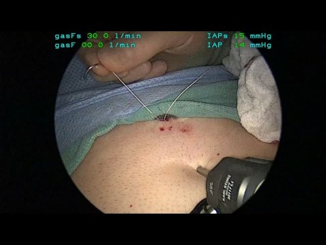Tutorial de la aplicación de fundoplicatura de geometría; Capítulo 04: Colocación de la sutura de retracción del hígado