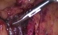 Laparoscopia como método diagnóstico más preciso en casos quirúrgicos agudos y neoplasias malignas intraperitoneales diseminadas