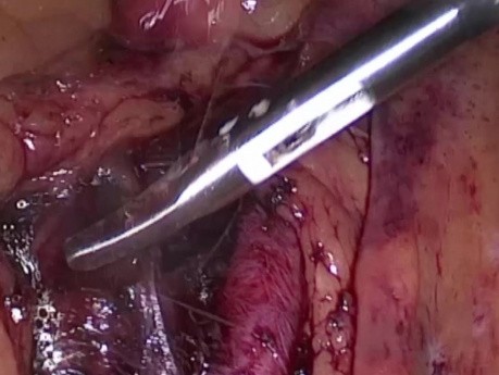 Laparoscopia como método diagnóstico más preciso en casos quirúrgicos agudos y neoplasias malignas intraperitoneales diseminadas