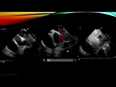 Evaluación ecocardiográfica de masas y neoplasias cardíacas