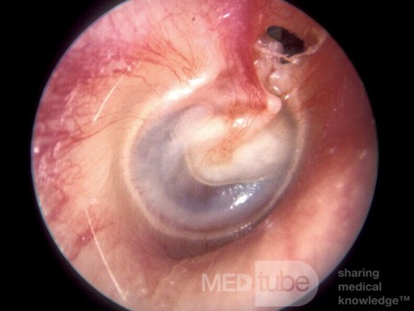 Colesteatoma del ático