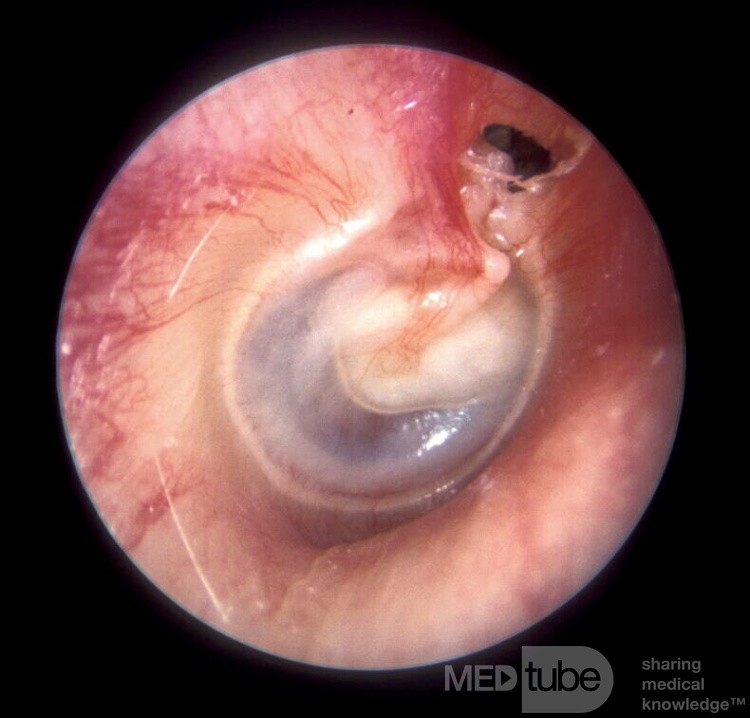 Colesteatoma del ático