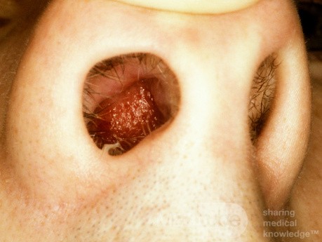 Hematoma del tabique nasal