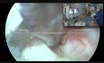 Reparación endoscópica de hernia discal y descompresión de la raíz S1