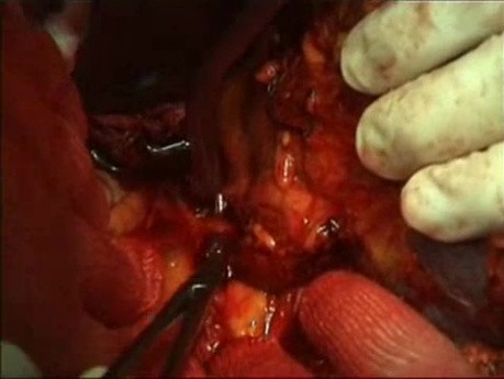 Vídeo de esplenectomía