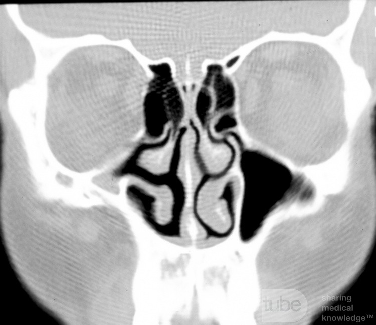 Hipoplasia del seno maxilar [tipo 3]