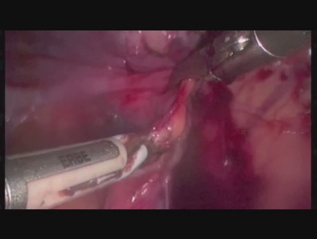 Anexectomía laparoscópica en el segundo trimestre del embarazo