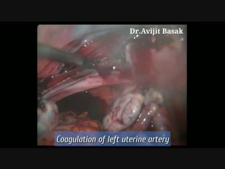 Paso a paso: histerectomía abdominal total y salpingooforectomía bilateral