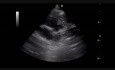 Defecto del tabique ventricular (VSD) subaórtico (2)