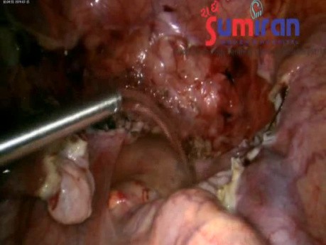 Tamaño uterino 24 a 26 semanas Gran masa 3D Difícil Histerectomía Total Laparoscópica (HTL)