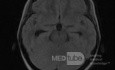 Tercera ventriculostomía endoscópica en un caso benigno de síndrome de Aicardi con hidrocefalia obstructiva y malformación de Chiari tipo 1