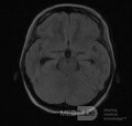 Tercera ventriculostomía endoscópica en un caso benigno de síndrome de Aicardi con hidrocefalia obstructiva y malformación de Chiari tipo 1