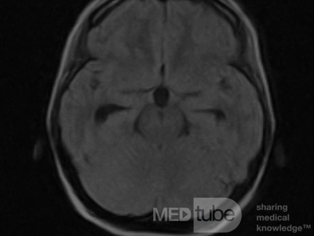 Tercera ventriculostomía endoscópica en un caso benigno de síndrome de Aicardi con hidrocefalia obstructiva y malformación de Chiari tipo 1