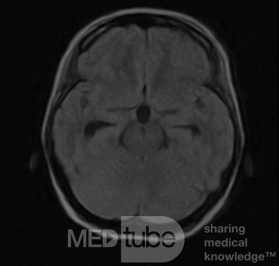 Tercera ventriculostomía endoscópica en un caso benigno de síndrome de Aicardi con hidrocefalia obstructiva y malformación de Chiari tipo 1