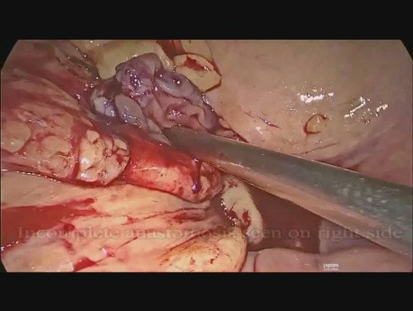 Revisión de la anastomosis después de la resección anterior laparoscópica