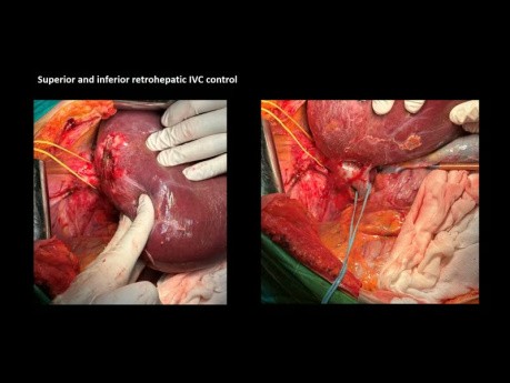 Resección hepática atípica sg 6-7-8 y colectomía izquierda para adenocarcinoma de colon izquierdo sincrónico y metástasis hepática de segmento único 7 - presentación de caso