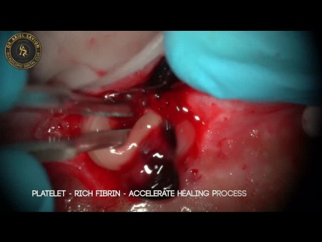 Microcirugía con diferentes láseres de longitud de onda (gingivectomía, frenectomía, apicectomía)