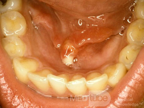 Papila sublingual de piedra con obstrucción