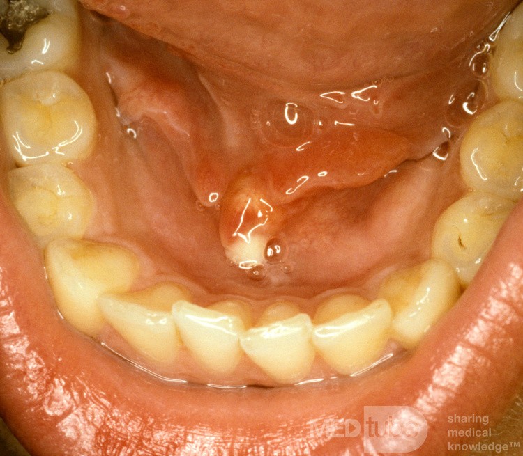 Papila sublingual de piedra con obstrucción