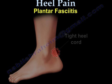 Fascitis plantar y dolor de talón - video-clase